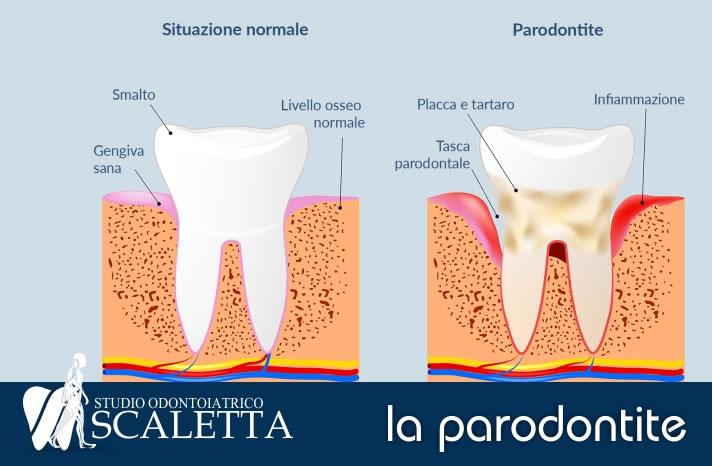 La parodontite è la causa principale di perdita di denti