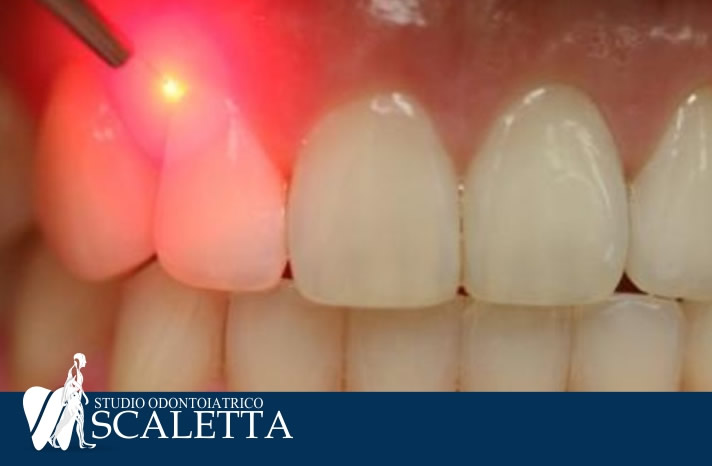 Parodontite  e  piorrea alveolare utilizzo del laser come parte integrante della moderna medicina