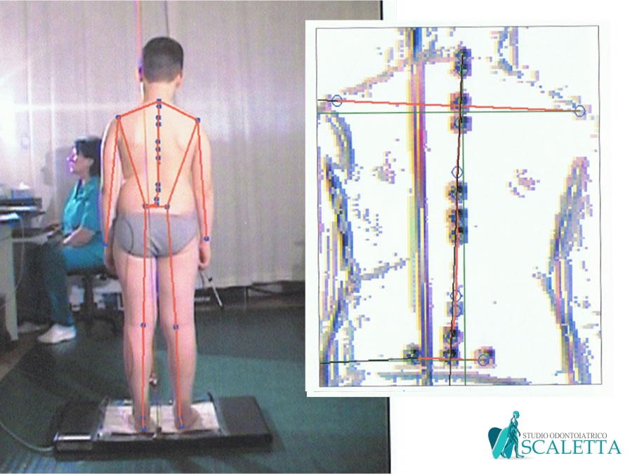 Caso clinico di correzione della postura