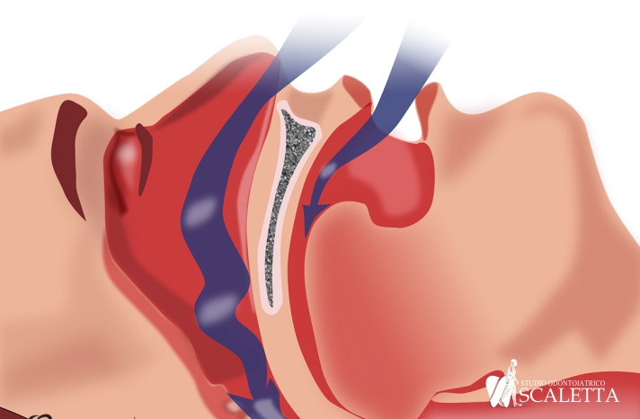 Relazione tra abitudini viziate, respirazione orale e malocclusione